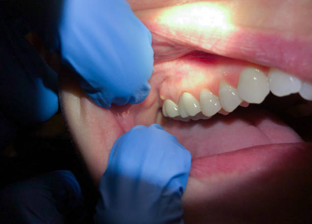 Best Emergency Tooth Extraction in Swifton, AR
